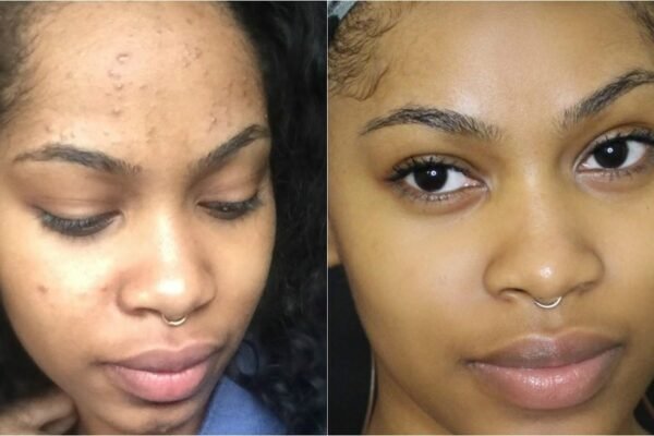 Acne vs. Face Rash