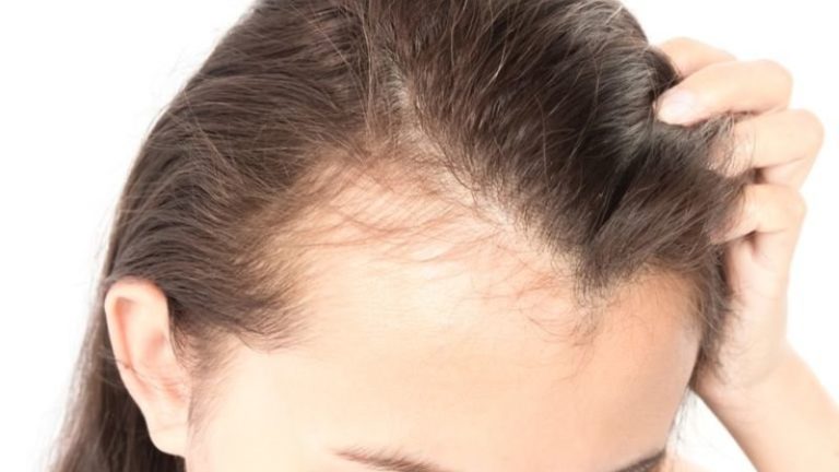 Why you Should Deal with Thinning Hair Early