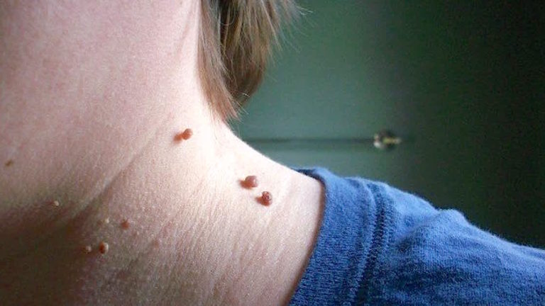 Are Skin Tags Harmful? And How To Get Rid of Them?